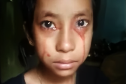Восьмилетняя девочка начала потеть и плакать кровью